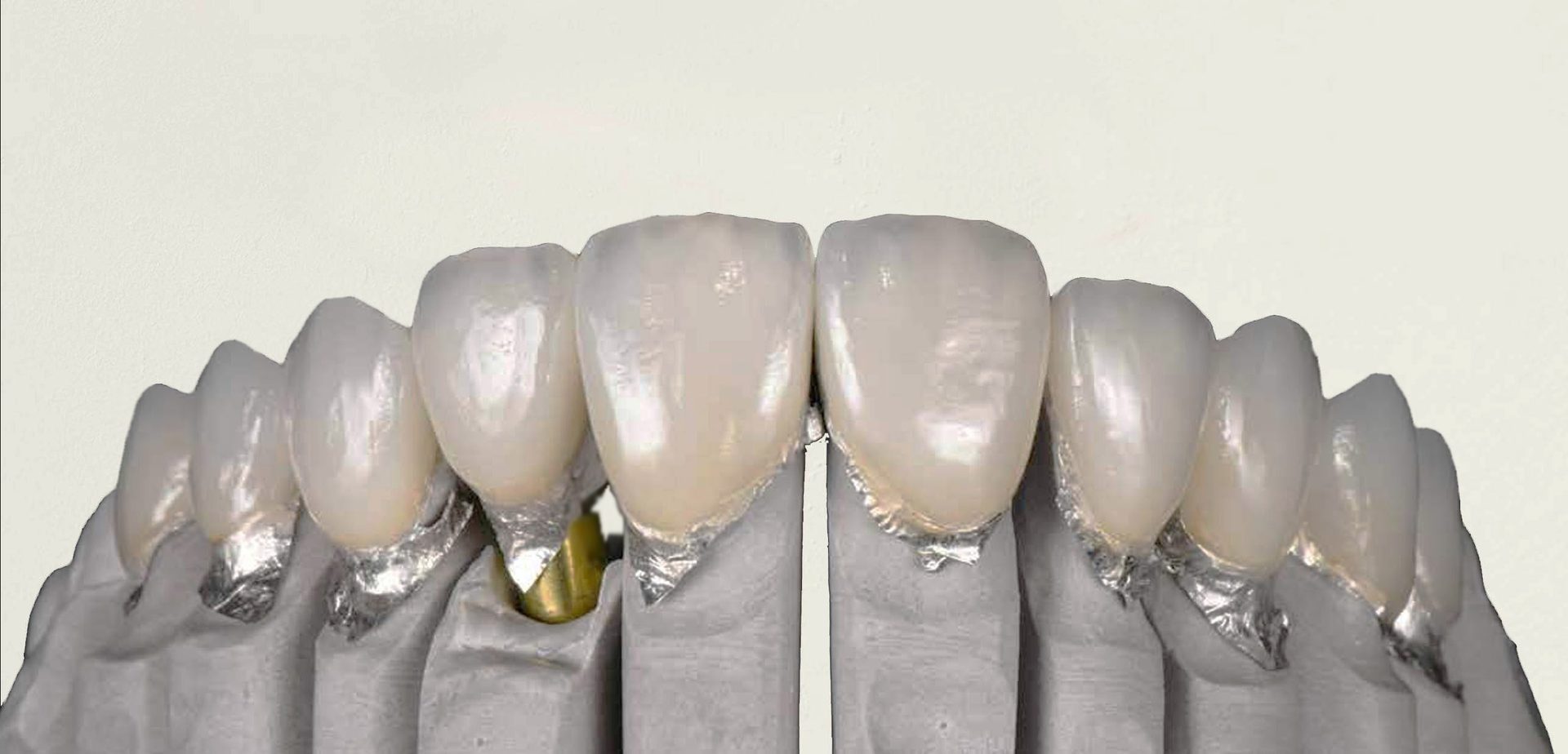 Do Veneers Damage Your Teeth? Dr. Fabbro, Jumeirah, Dubai