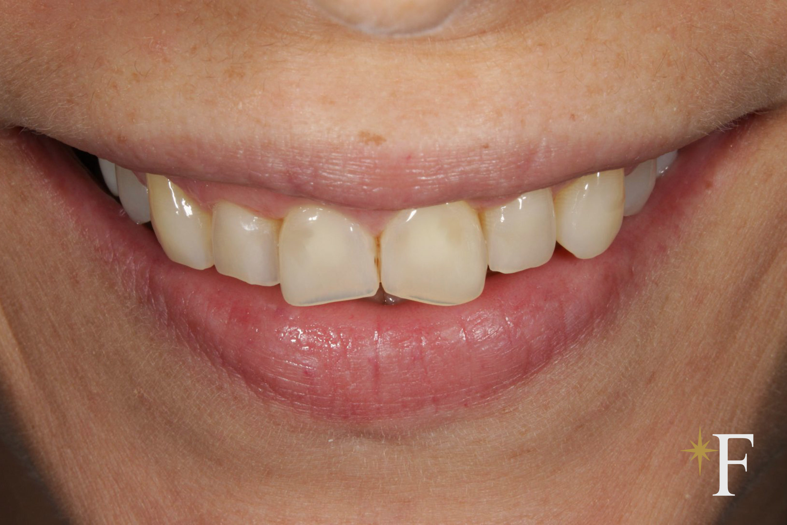 Before treatment with Dr. Fabbro, the starting point