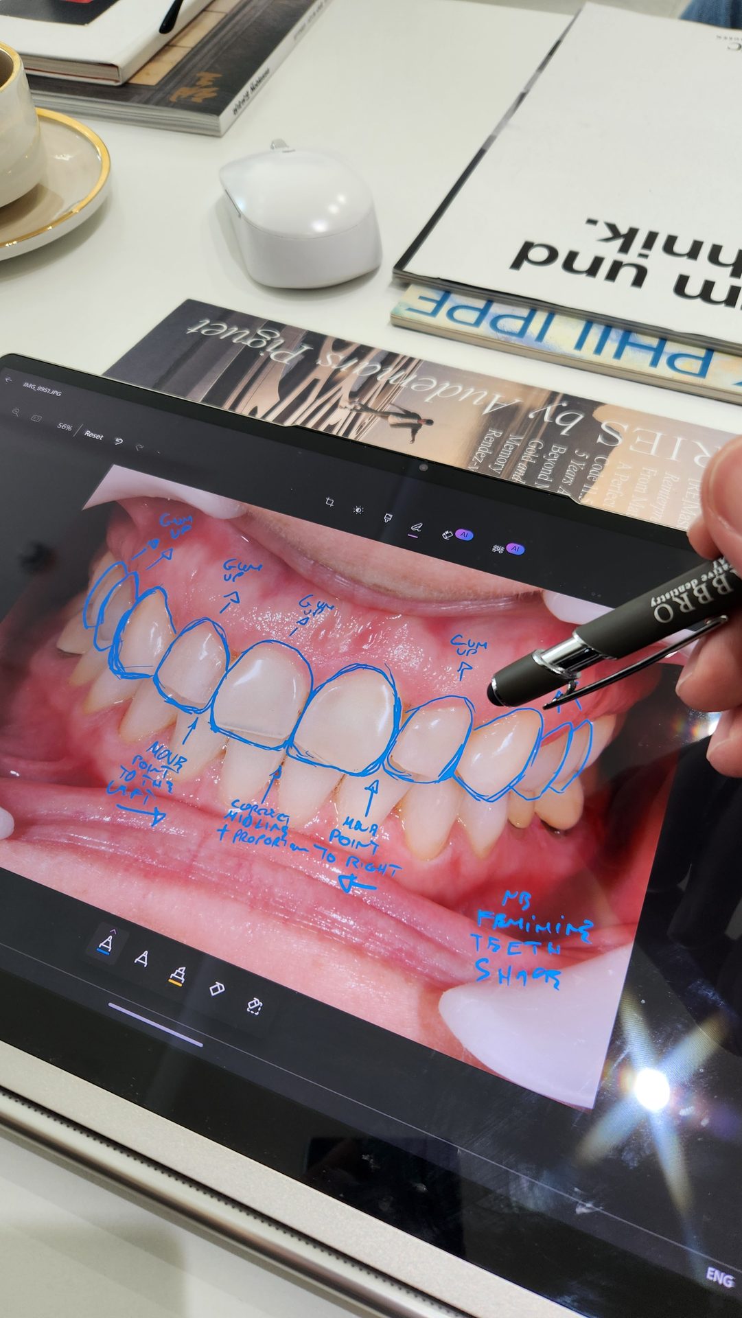 When to Whiten, and When to Veneer Dr. Fabbro, Jumeirah, Dubai