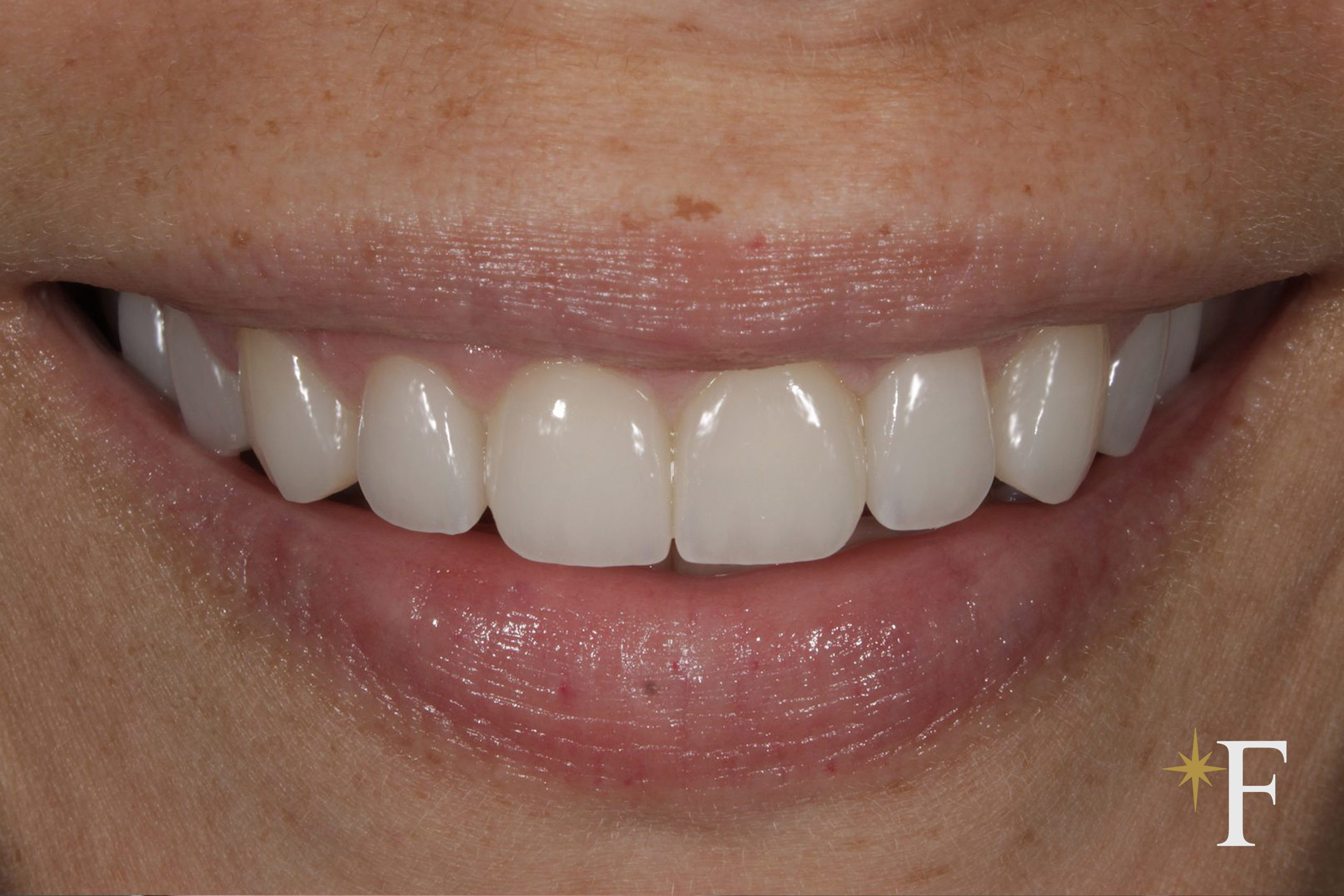 After treatment with Dr. Fabbro, a natural, unretouched result