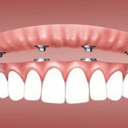 Bridge over implant Bridge over implant