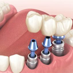 dental implants 2
