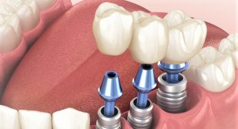 Dental Implants: Restoring More Than Just a Smile