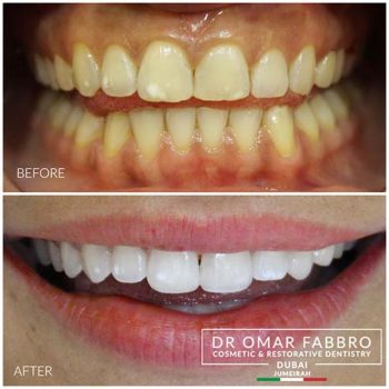 Veneers Dr. Omar Fabbro LR