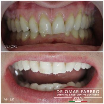 Whitening 10 Dr. Omar Fabbro