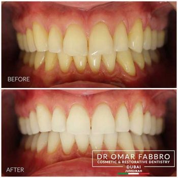 Whitening 2 Dr. Omar Fabbro