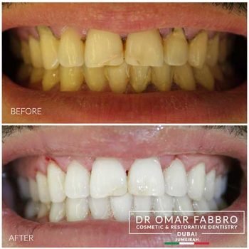 Whitening 3 Dr. Omar Fabbro