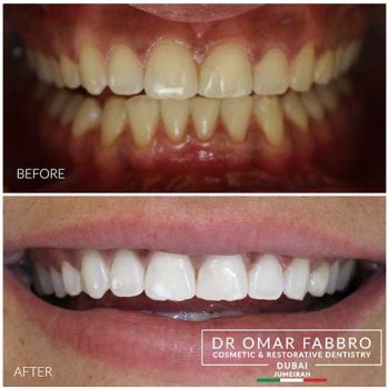 Whitening 4 Dr.Omar Fabbro