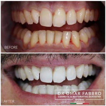 Whitening 5 Dr. Omar Fabbro