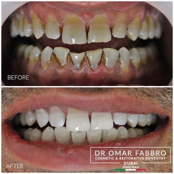 Whitening 7 Dr. Omar Fabbro