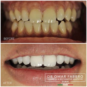 Whitening 8 Dr. Omar Fabbro