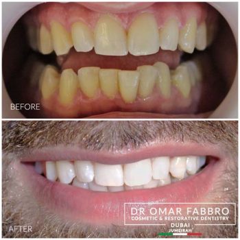 Whitening 9 Dr. Omar Fabbro