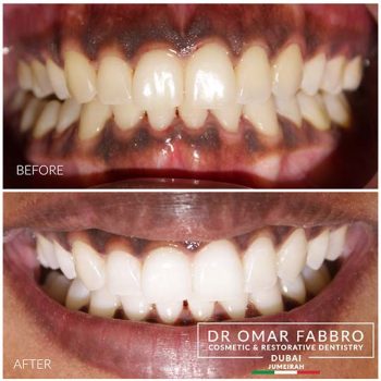 Whitening Dr. Omar Fabbro